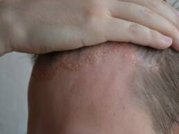 Psoriasis du cuir chevelu : traitements et conseils pratiques ...